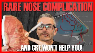 SEVERE NOSE COMPLICATION: What to do when CRT is normal but pain is 10/10 [Aesthetics Mastery Show]