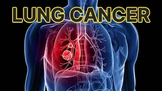 Lung Cancer (updated 2023) - CRASH! Medical Review Series
