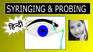 (हिन्दी)| Lacrimal Syringing & Probing | For Exams