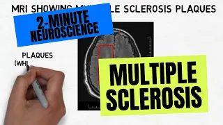 2-Minute Neuroscience: Multiple Sclerosis