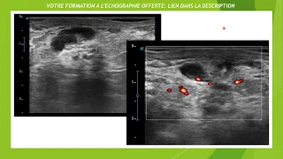 Galactophorite en échographie