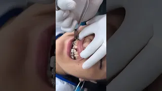 Dentista Tira o Aparelho e o Dente sai Junto. ENTENDA!! #shorts