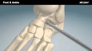 Stryker Foot and Ankle | SubFix™ Arthroeresis Implant Animation