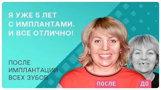 У меня импланты простояли уже 5 лет. Рассказываю, как ухаживать за ними