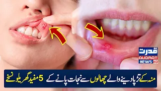 5 useful home remedies to get rid of sore mouth sores