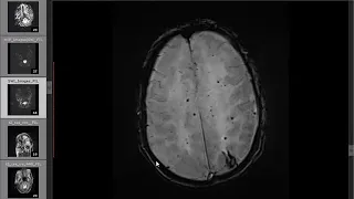 Amyloid Angiopathy