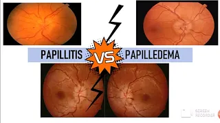 PAPILLITIS v/s PAPILLEDEMA