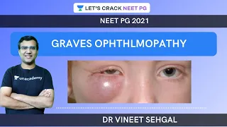 Graves Ophthlmopathy |  NEET-PG 2021 | Vineet Sehgal