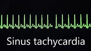 Cardiovascular System 8, Normal and abnormal heart rhythms