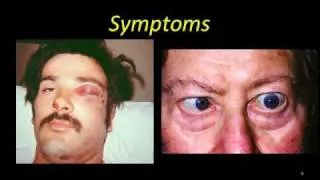 Cavernous Sinus Thrombosis