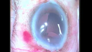 Techniques Of IOL Explantation in Phacoemulsification Surgery