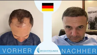 Haartransplantation Vorher Nachher Türkei | Dr. Bayer Clinics