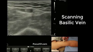 Scanning the Basilic Vein with Ultrasound