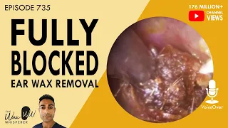 735 - Fully Blocked Ear Wax Removal