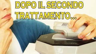 Epilatore a luce pulsata: funziona? Il trattamento continua  2