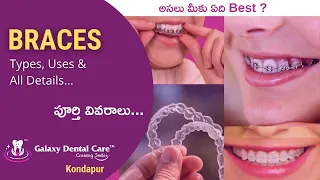 What are the Braces? Best Orthodontics in Hyderabad | Galaxy Dental Care Kondapur