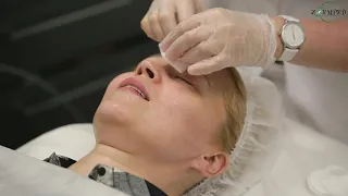 Биоармирование лица. Биоармирование жидкими нитями FIBROLIFT