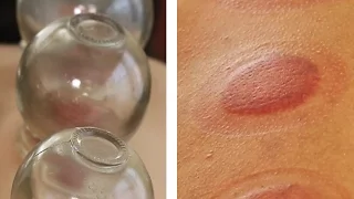 Would You Try Fire Cupping?