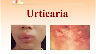 What is Urticaria | Clinical Manifestation | Diagnosis & differential diagnosis | Treatment