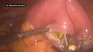 laparoscopic roux en -y -gastrojejunostomy(technical demonstration)