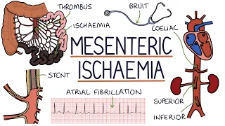 Understanding Mesenteric Ischaemia