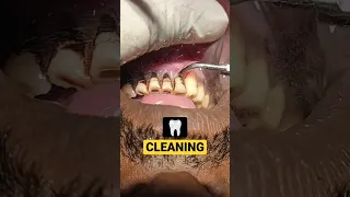 Pan - Smokers Teeth Cleaning #teethcleaning #dirtyteeth