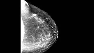 Dense breast tomosynthesis