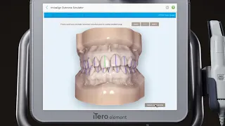 iTero® Scanner Tutorial: Invisalign Outcome Simulator