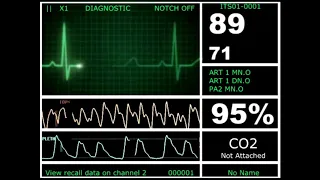 Hospital Monitor Flatline to Alive (HD)