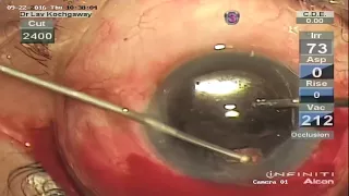 Anterior Chamber IOL, Vitreous in AC