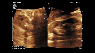 Nephrolithiasis - Renal Calculi || Ultrasound || Case 08