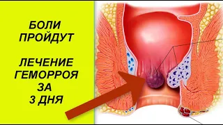 Лечение ГЕМОРРОЯ быстро и эффективно Психосоматика заболевания