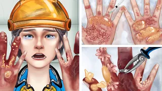 ASMR｜Removal of pus from the hand of a chemically corroded female worker｜부식된 손 치료