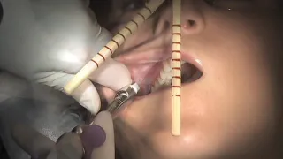 VTS 07 1 Techniques for Successful Local anesthesia