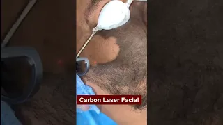 Carbon Laser Treatment Will Make You Tons Of Cash. Here's How #carbon #Carbon_laser_facial #shorts