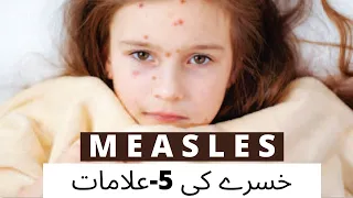 Symptoms and signs of Measle #measles #kids #signs