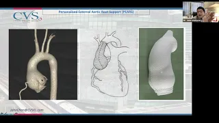 The best treatment for Thoracic Aortic Aneurysms