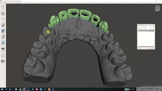 Periodontal surgical guide with Meshmixer