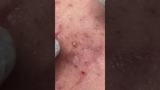 Newest pimple popping video 2021 D#140