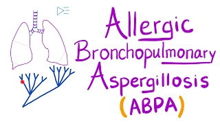 Allergic Bronchopulmonary Aspergillosis (ABPA)