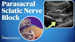 Ultrasound Guided Parasacral Sciatic Nerve Block