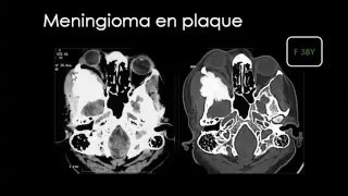 Imaging of Brain tumors   Dr Mamdouh Mahfouz In Arabic