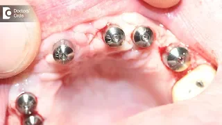 How many Dental Implants can I do at one time? - Dr. Arundati Krishnaraj