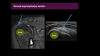 Musculoskeletal (MSK) Ultrasound Basics