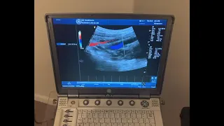 Ultrasound Imaging of the Common iliac arteries
