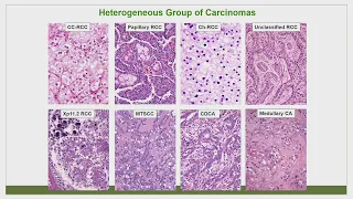 A Diagnostic Approach to the many Subtypes of Renal Cell Carcinoma by Michelle S. Hirsch, M.D., Ph.D