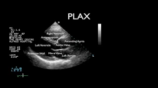 Standard 2D Echo Views