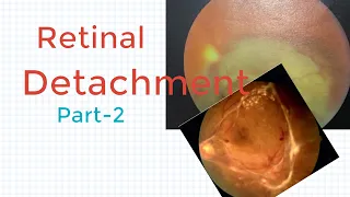 Retinal Detachment (Exudative Retinal Detachment, Tractional Retinal Detachment) and its treatment.