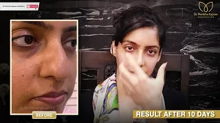 Happy Patient Testimonial (Nose job) | Rhinoplasty & Septoplasty | Stunning Result #drmonishakapoor