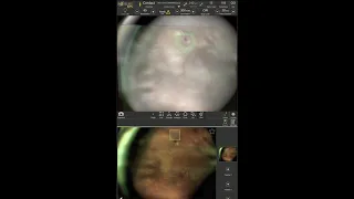 Non-contact navigated laser photocoagulation of a retinal tear using Navilas 577s